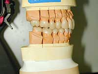 咬合器上で治療用仮歯を作製