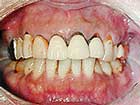 1. 歯周炎の初診時