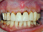 2. 歯肉・歯槽形態修正術後
