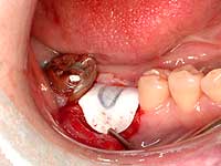メンブレンを用いたバリアーテクニックにより歯周組織再生を図ります。