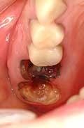 2. 冠除去後。手前の大臼歯は頬側根に破折がみられた