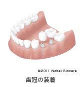 歯冠の装着